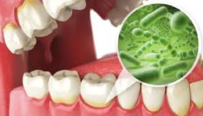Bakteri Porphyromonas Gingivalis Bisa Ditekan Lewat Blokir Sinyal AHL di Plak